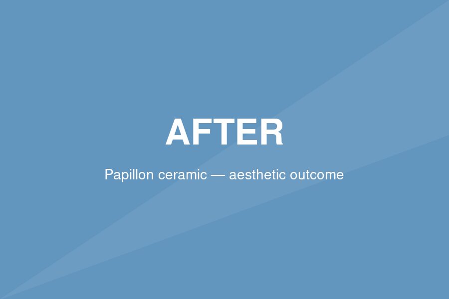 After — Aesthetic outcomes adult patients ask for — Papillon ceramic